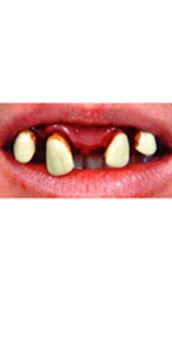 Jethro Billy Bob Teeth