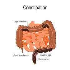 All you need to know about constipation
