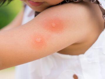 Insect bites and stings
