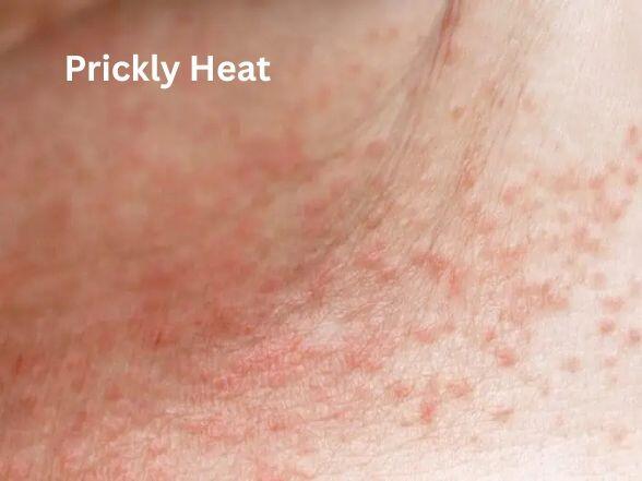 How to Prevent and Treat Prickly Heat Rash This Summer