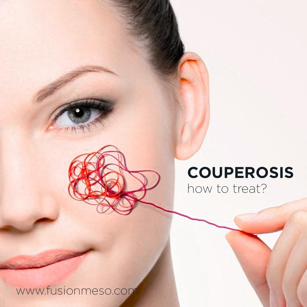 How to treat Couperosis