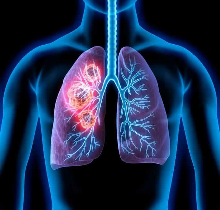 Can Elf bars cause lung problems?