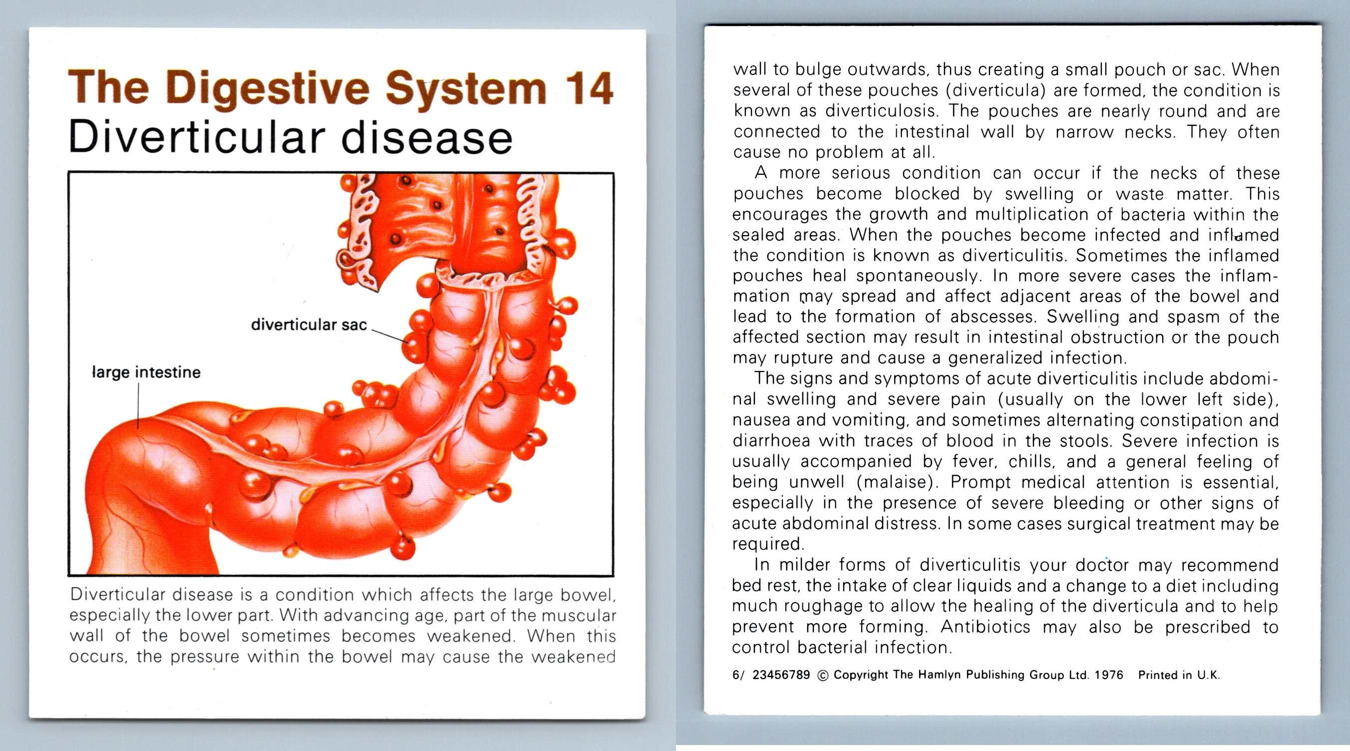 Diverticular Disease 14 Digestive System Home Medical Guide 19758