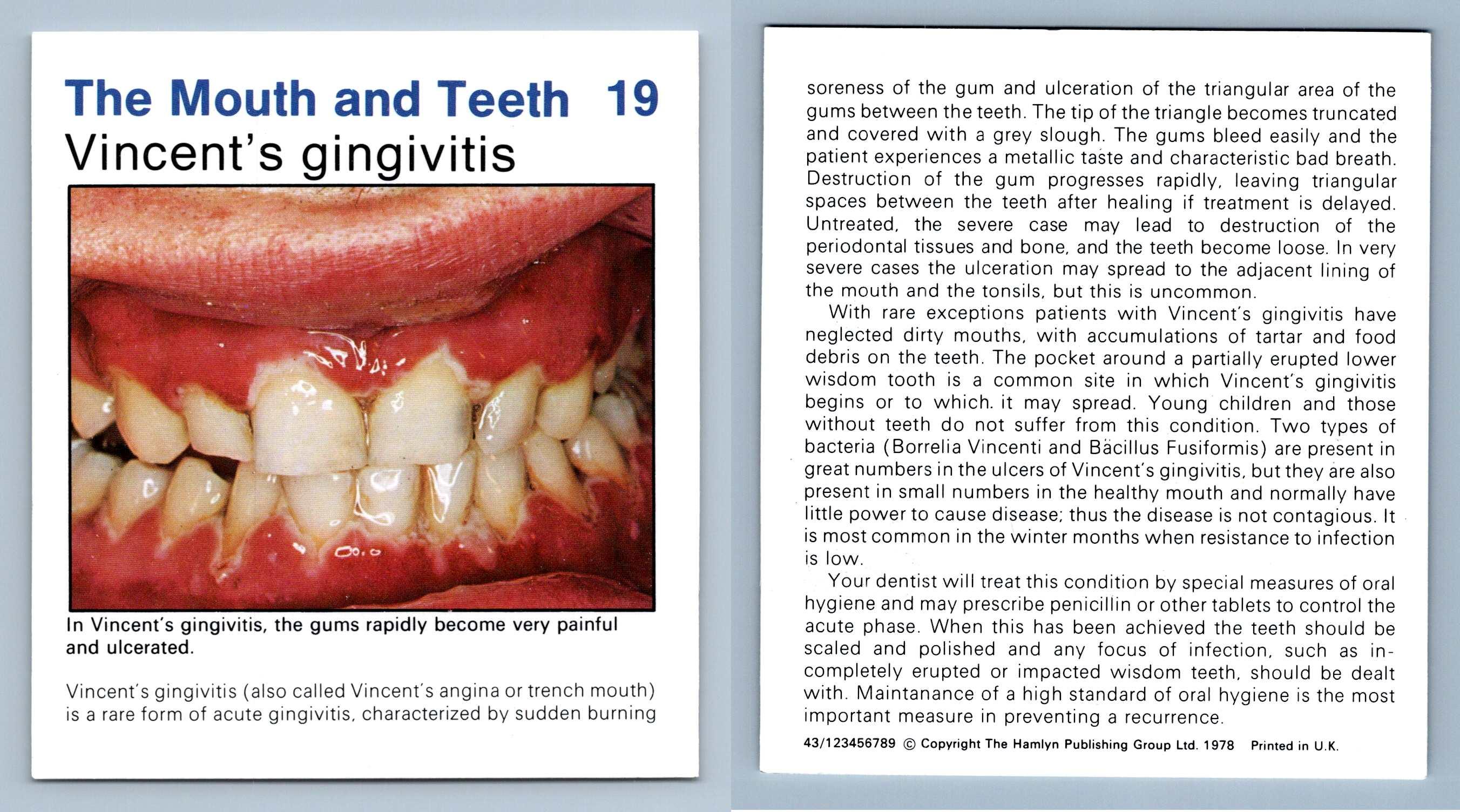 What Is Gingivitis And What Is The Cost Of Gingivitis, 50 OFF