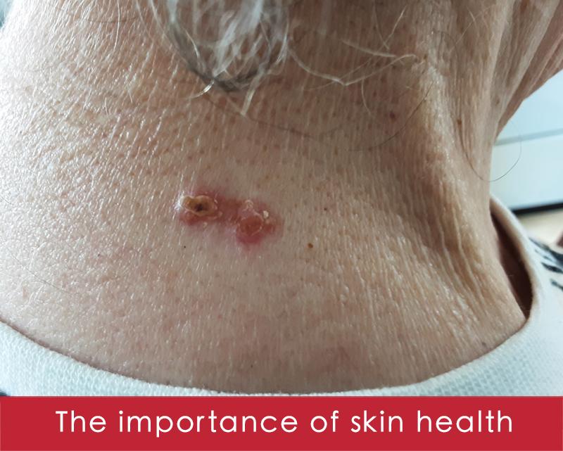 Jan's story...diagnosed with skin cancer