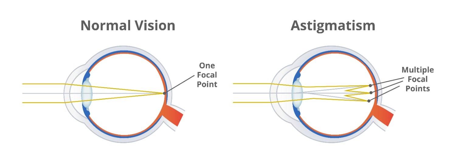 Astigmatism What It Is How Glasses Can Help