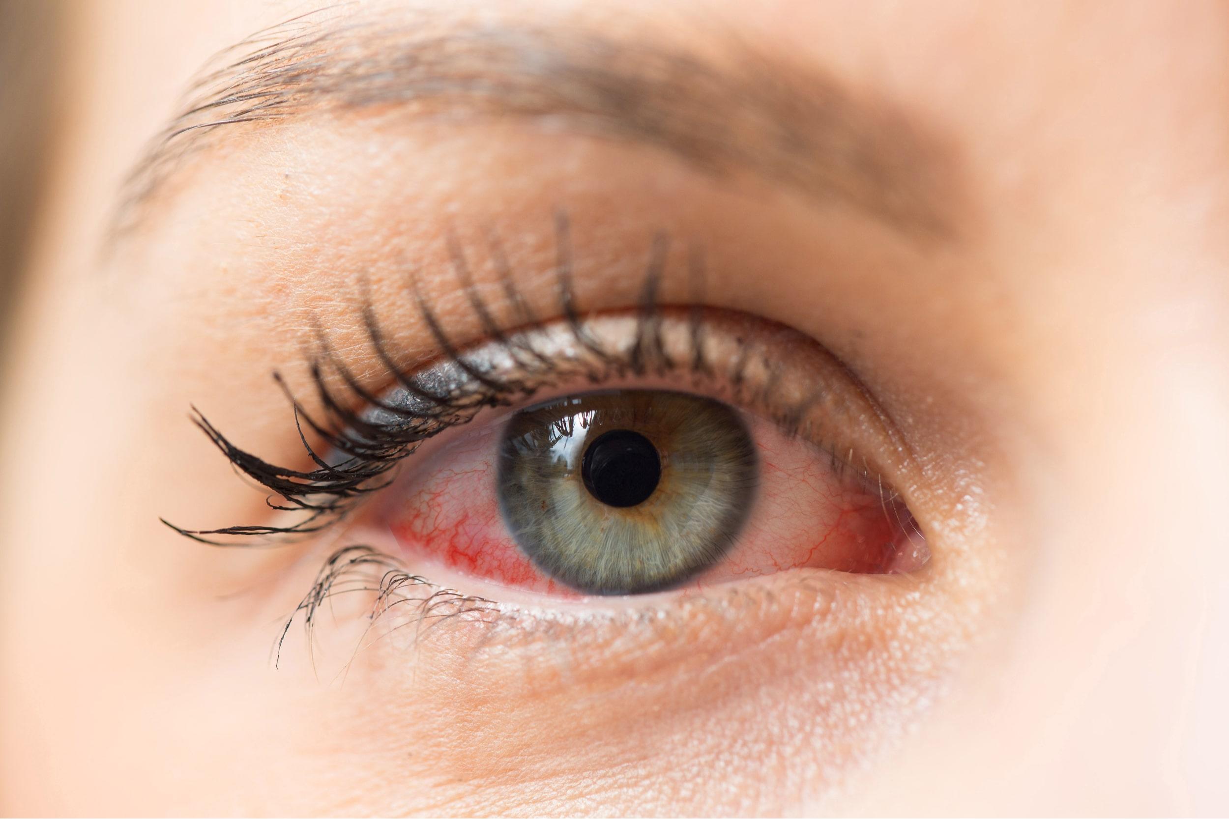 eye allergy