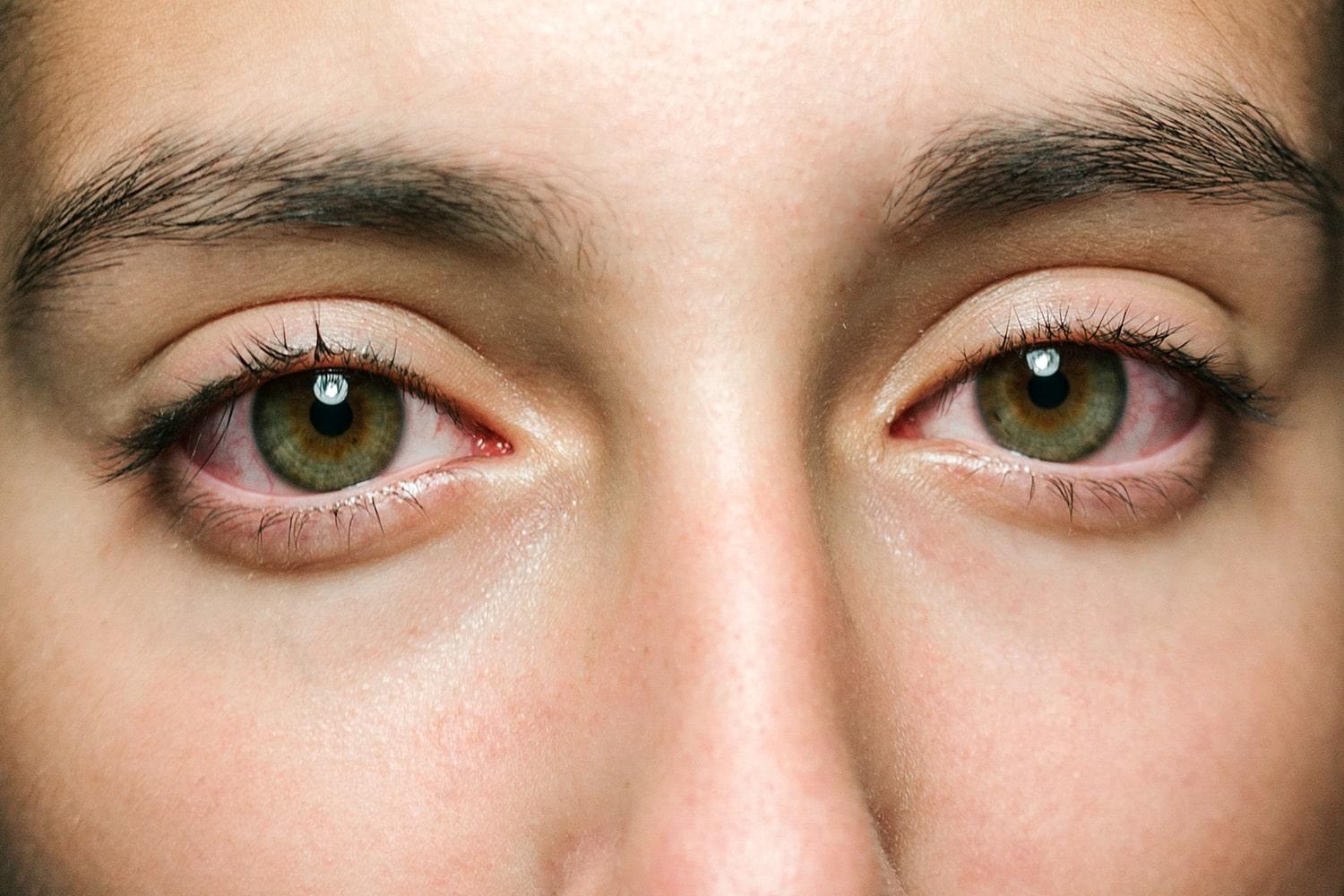 5 Best Natural Remedies for Tired Eyes