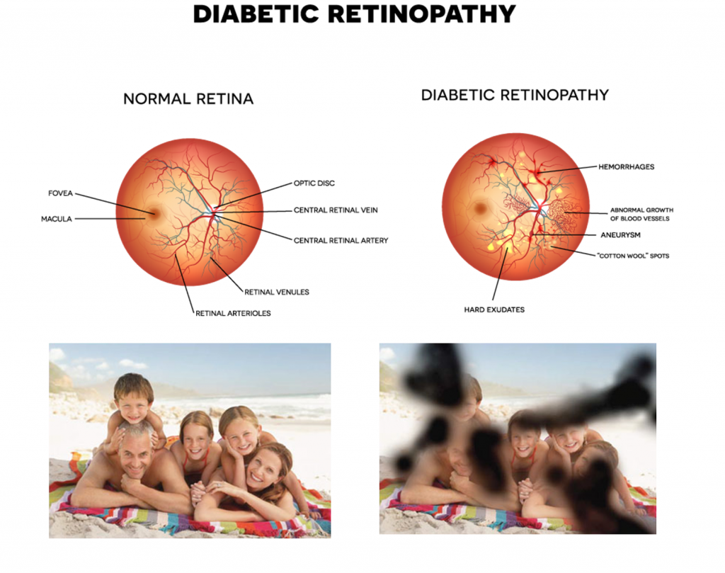 Eye Conditions Diabetic Retinopathy Visionaid