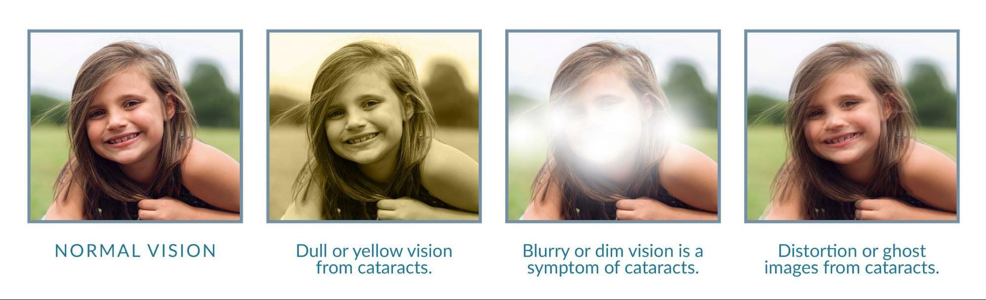 eye-conditions-cataracts-visionaid