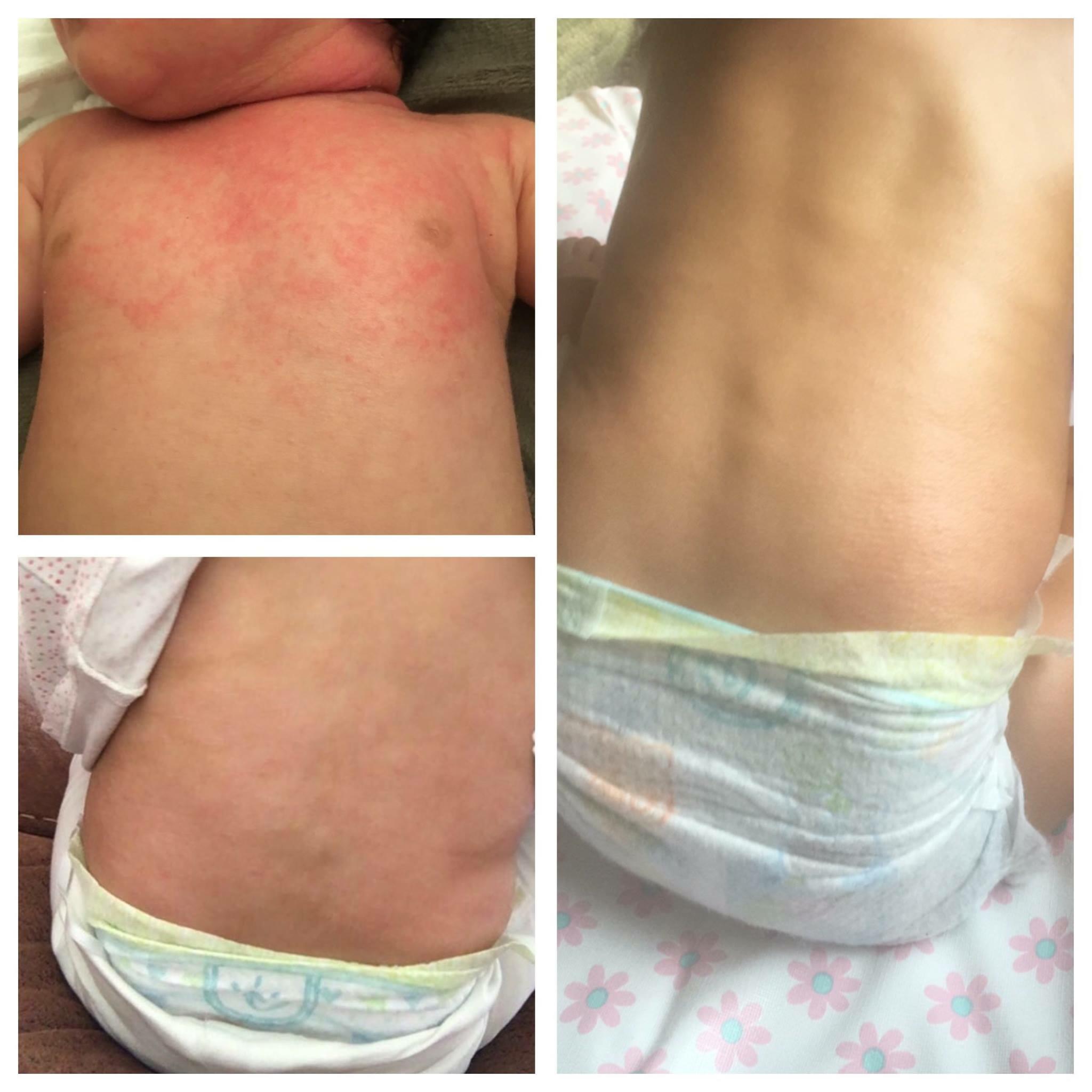 new-eczema-treatment-baby.jpg