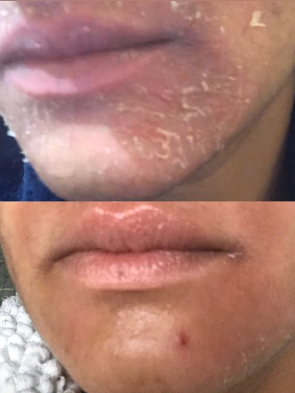 perioral dermatitis