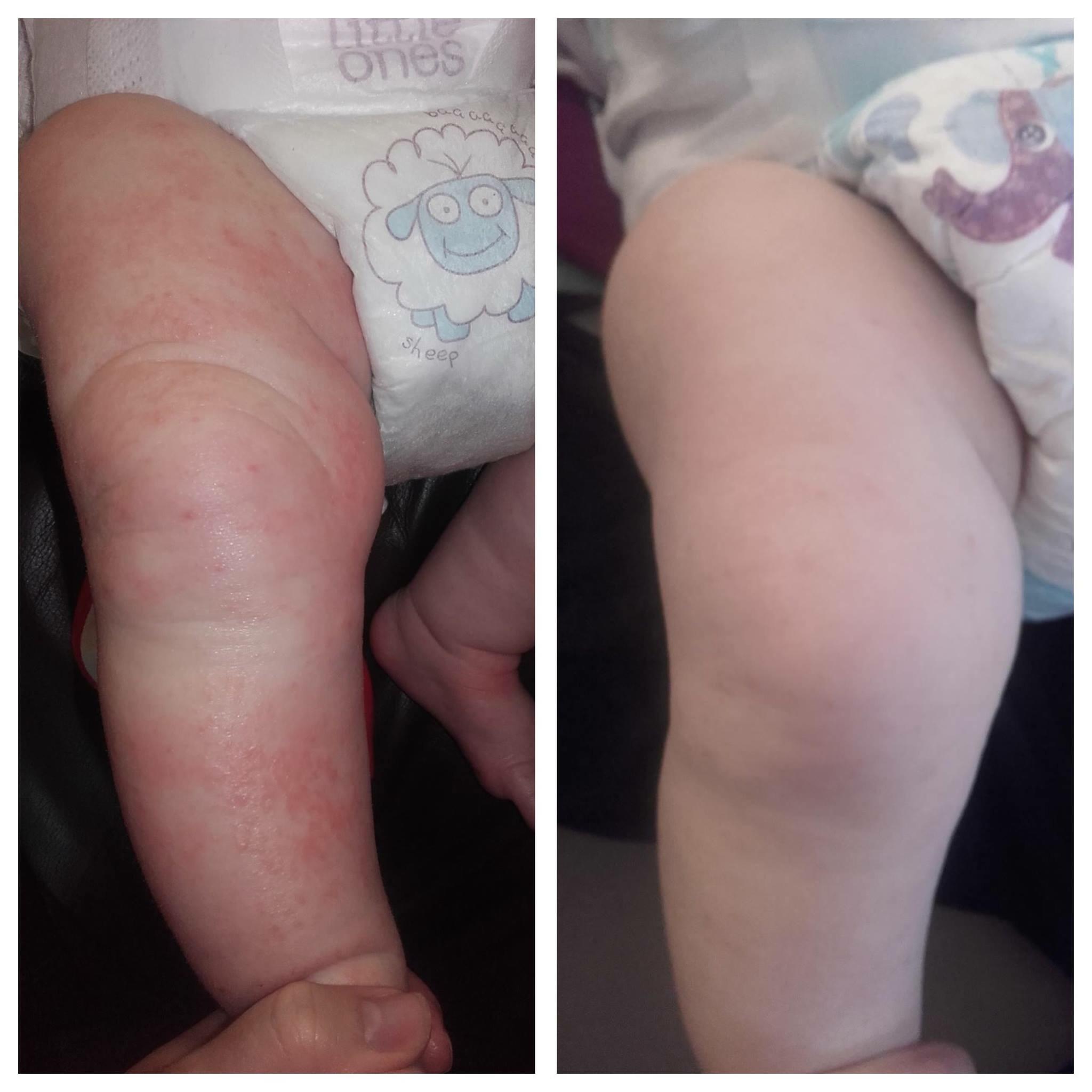 eczema-cure.jpg