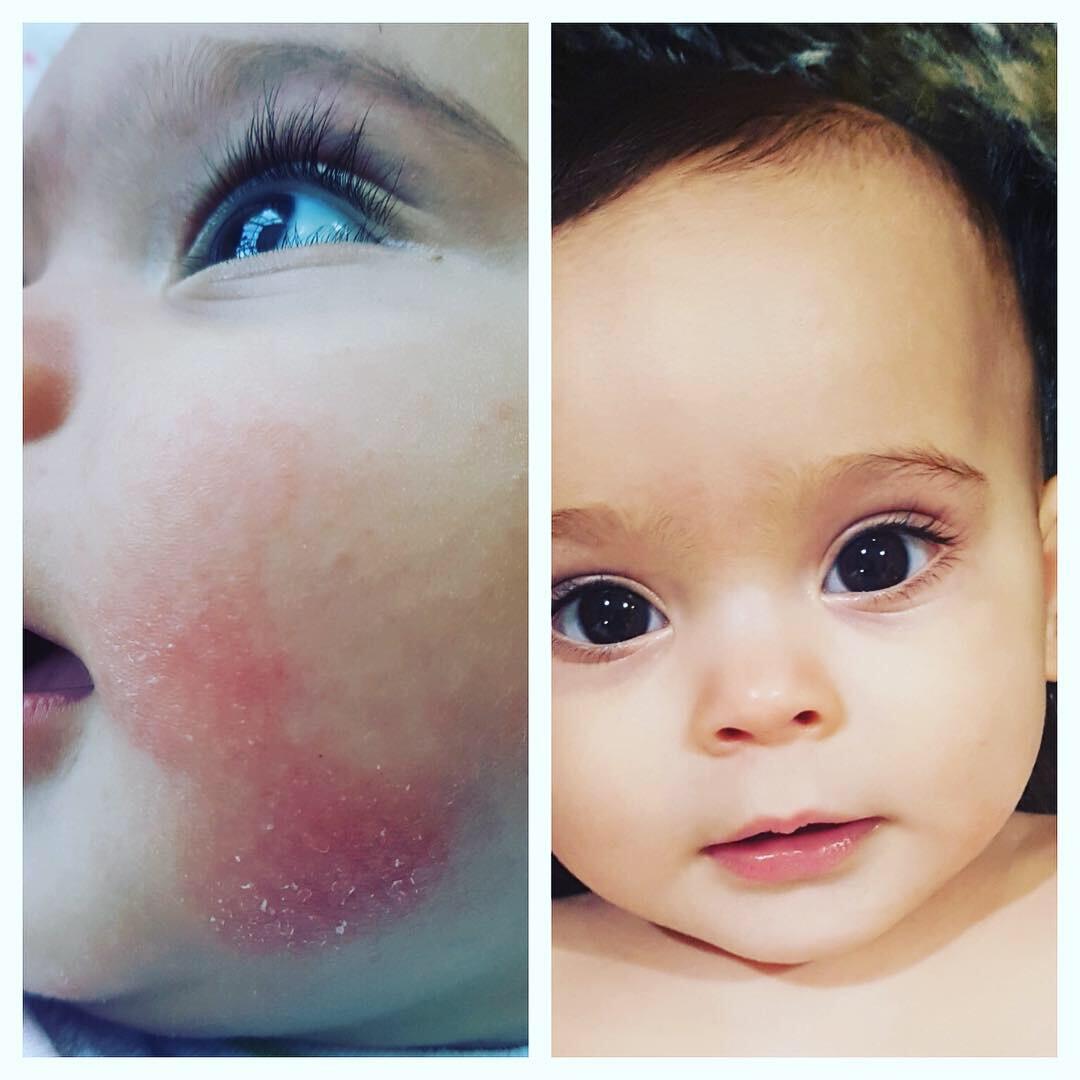 baby eczema face