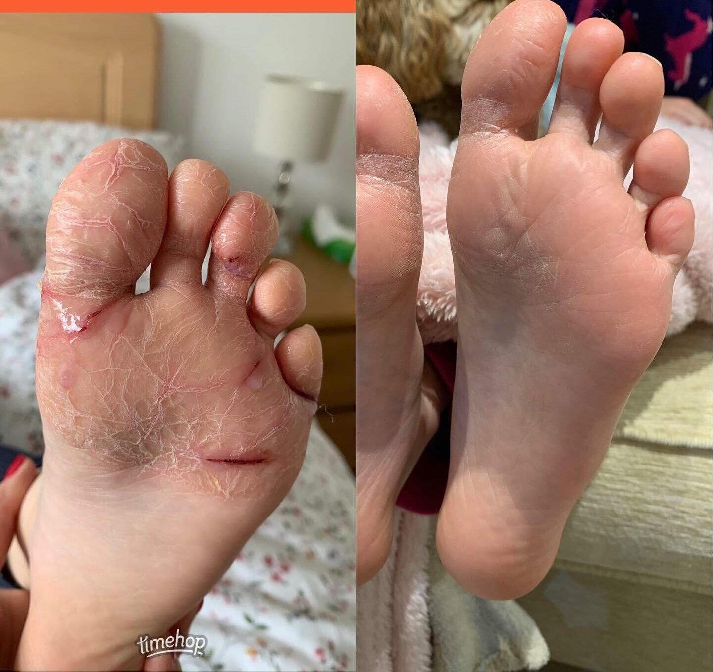 foot eczema cure