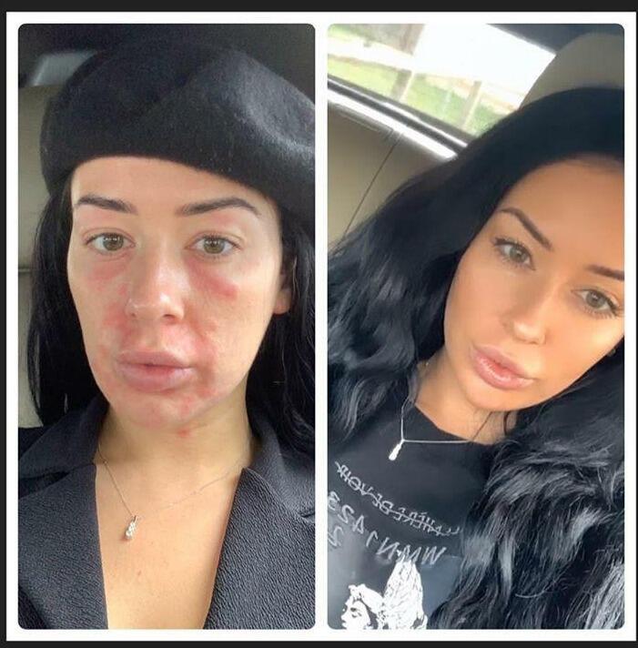 face rash cure