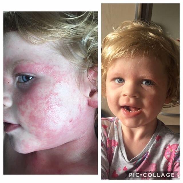 imogen-face-eczema-baby-eczema.jpg