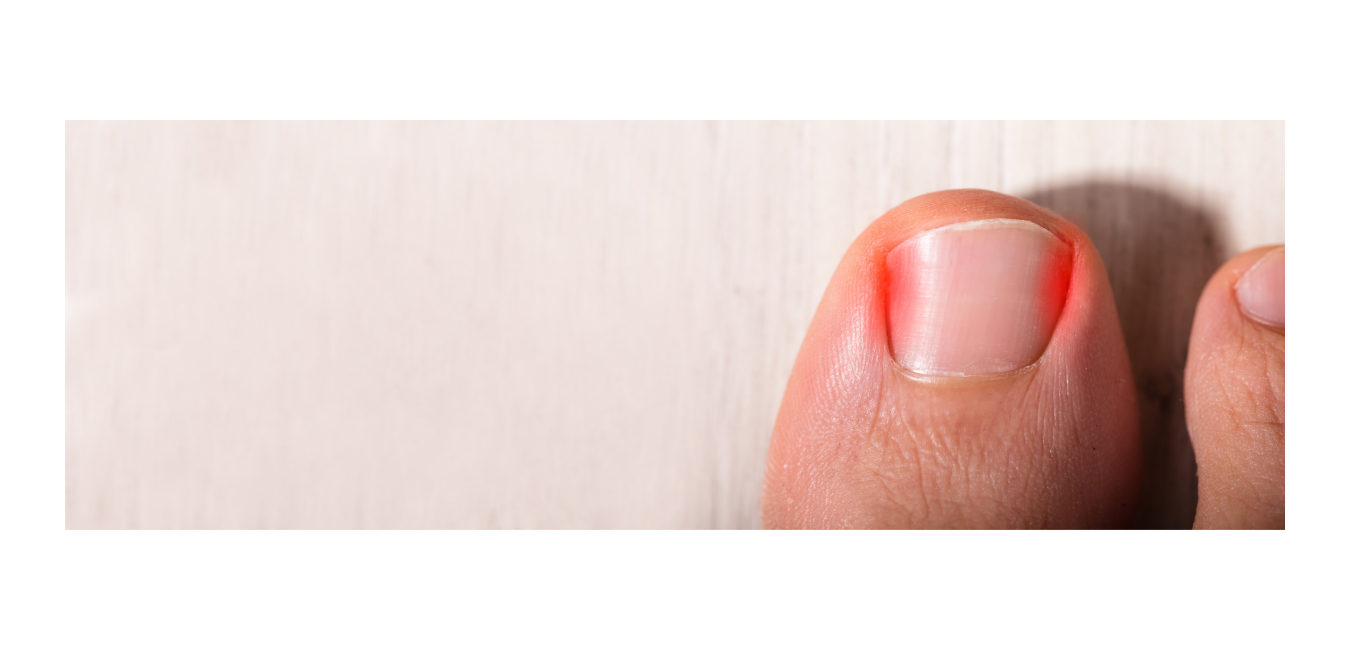 Nail reconstruction — Pulse Podiatry%