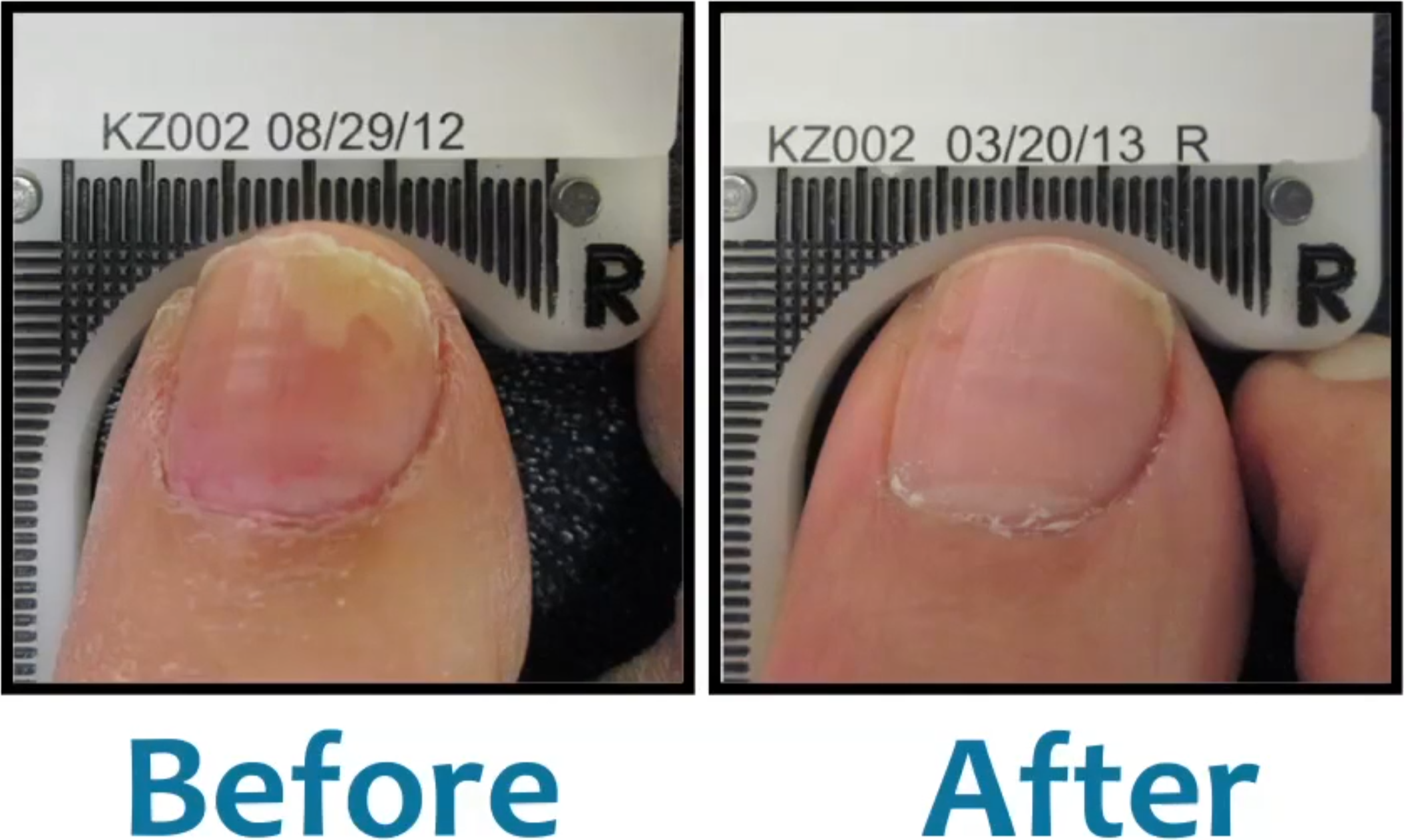 Fungal infections — Fitzroy Foot and Ankle Clinic