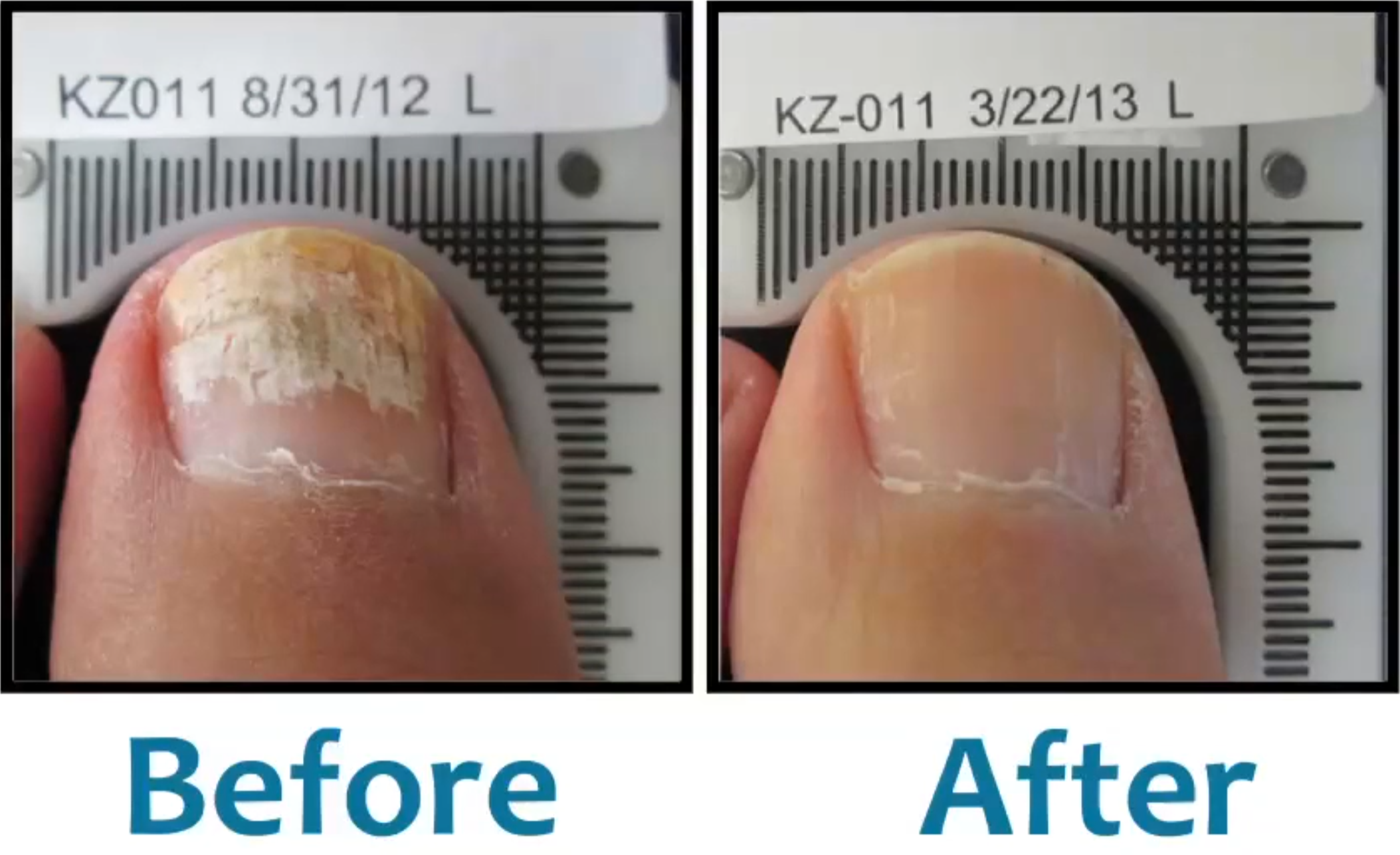 Auckland's Lunula Cold Laser for Fungal Toenails - Clear Step Podiatry
