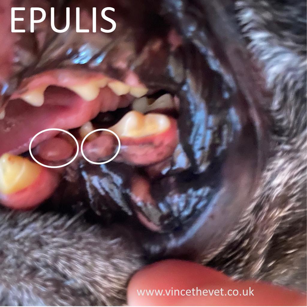 Epulis - What Is it And How is it Best Treated?